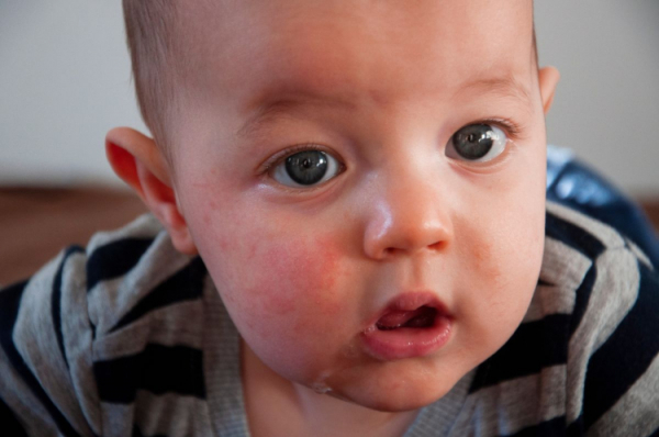 Alergia u niemowlaka – po czym ją rozpoznać?